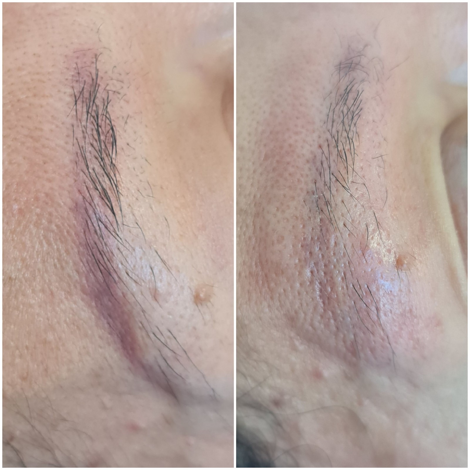 photo détatouage sourcils violets résultat avant après la ciotat marseille  Toulon