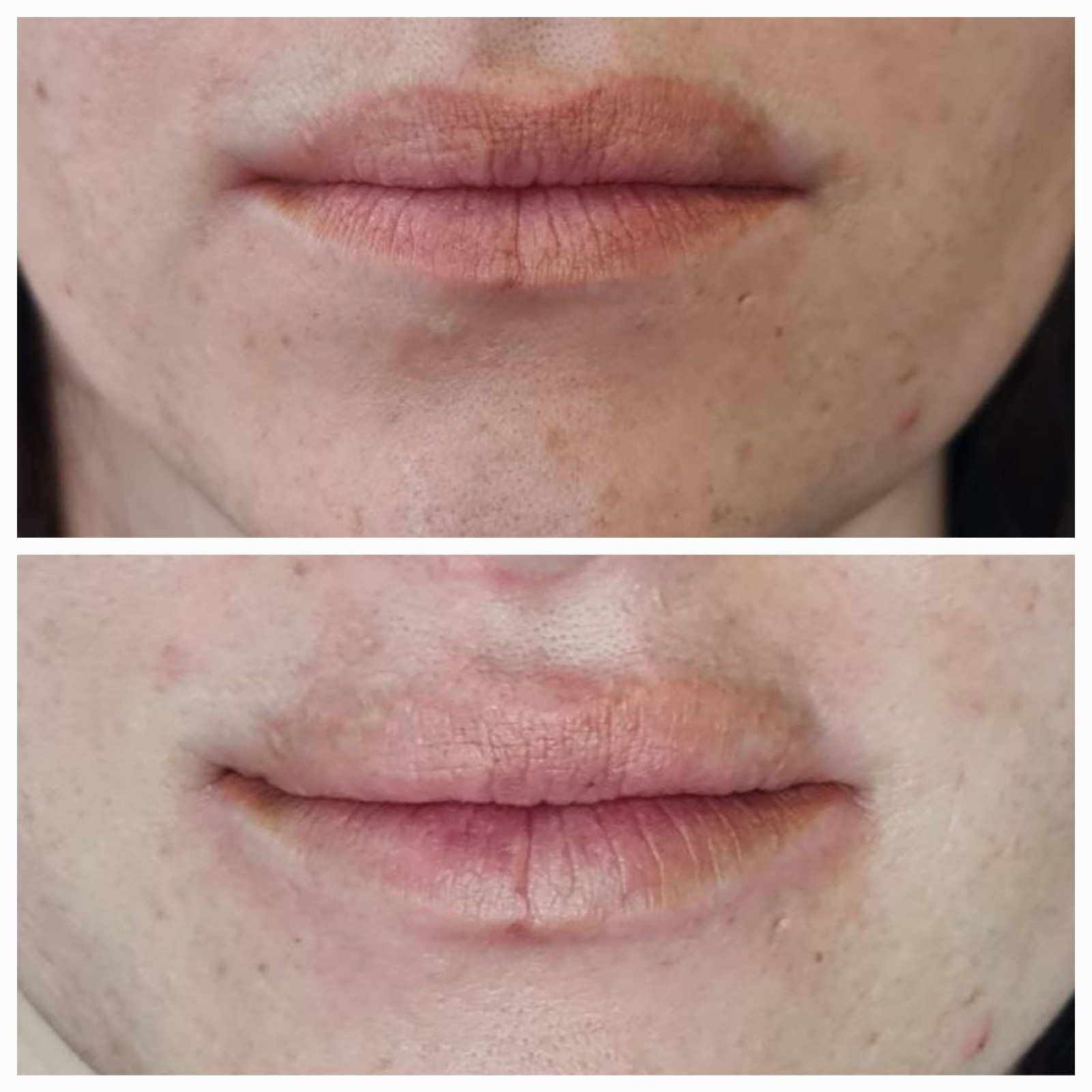 Traitement de détatouage lèvres sur-mesure pour peaux sensibles à La Ciotat avant après