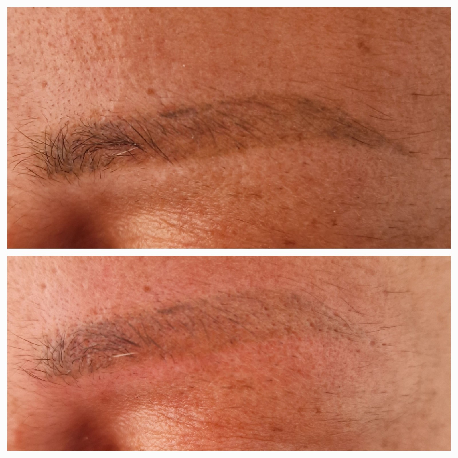 effacer ancien tatouage sourcils  sans traumatiser la peau sans douleur meilleure machine
