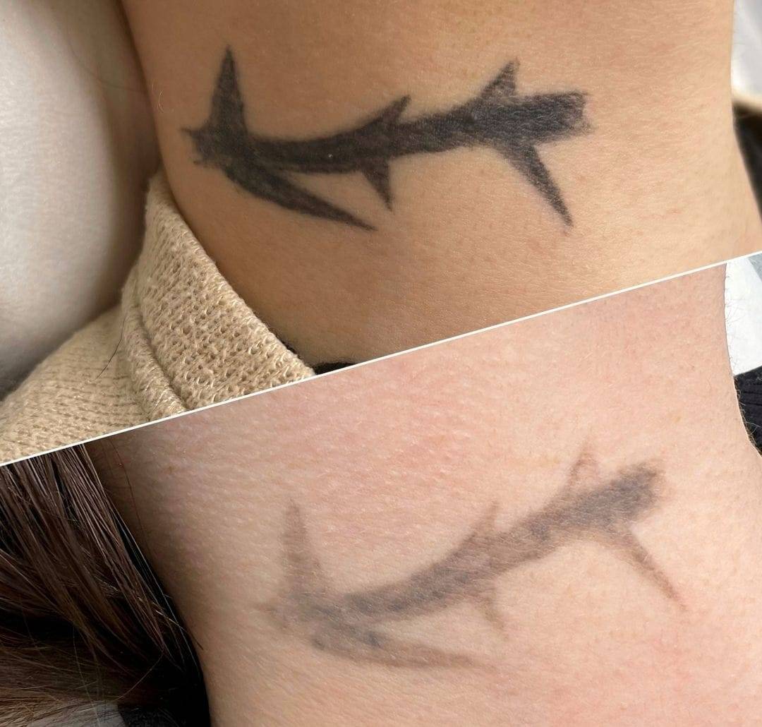 détatouage dermopigmentation marseille