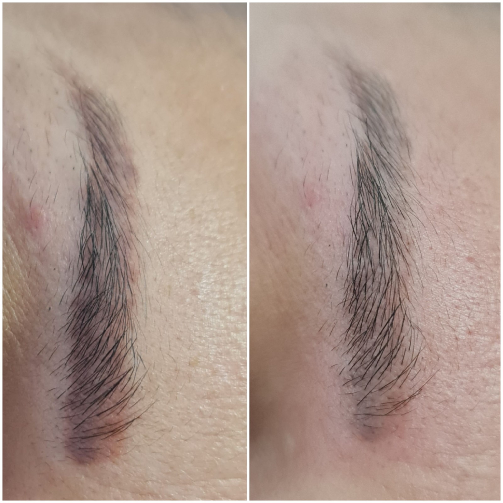 Détatouage combien de séances il faut prévoir pour les sourcils bleus rouges ou violets les résultat avant après? 