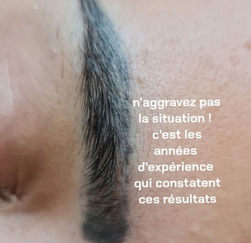 Avant/Apres détatouage chez Black Line Studio – Adieu le contour gris !