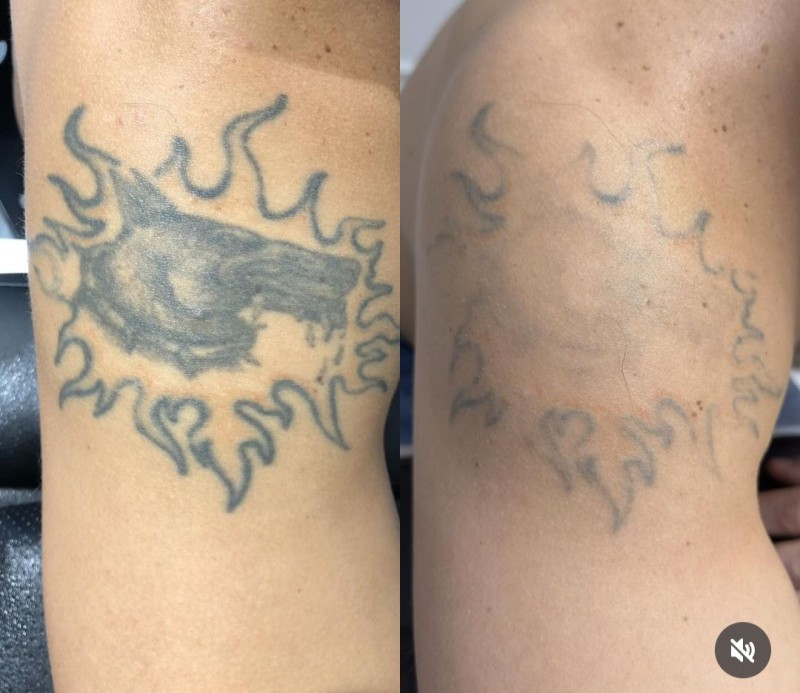 Le détatouage laser à La Ciotat : effacez vos anciens tatouages sans douleur