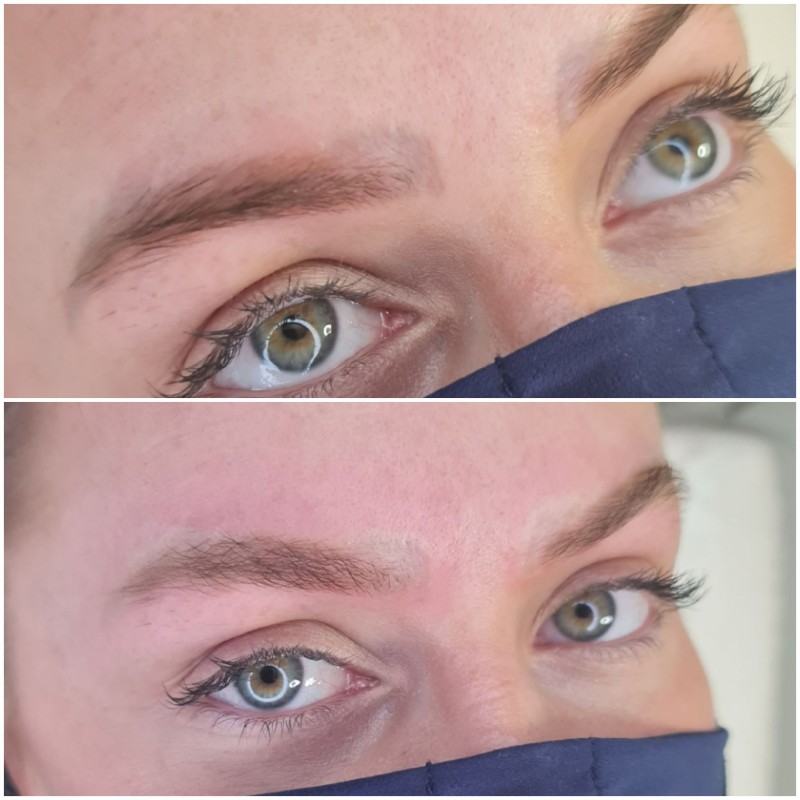 détatouage sourcils laser cicatrisation Aix-en-Provence