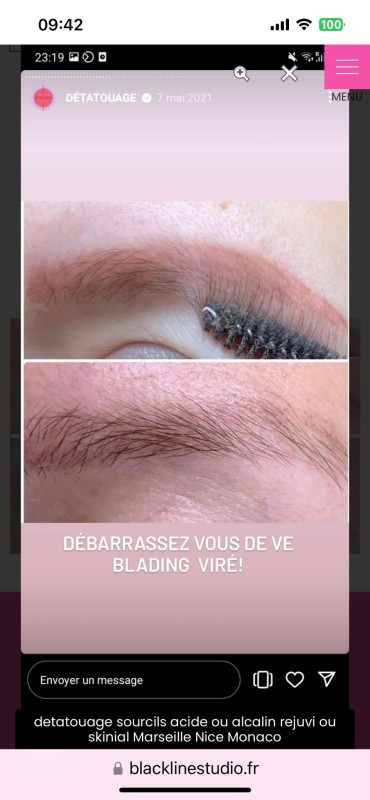 retrouver sa peau sans tatouage avec la methode de détatouage adaptée
