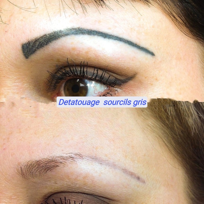 Centre de détatouage : faites disparaitre votre dermopigmentation taches de rousseur à La Ciotat