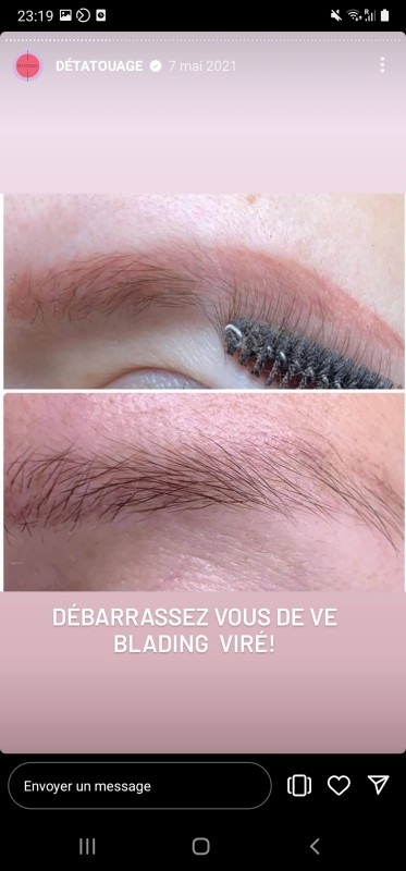 Meilleur détatouage de microblading sourcils rouges Marseille