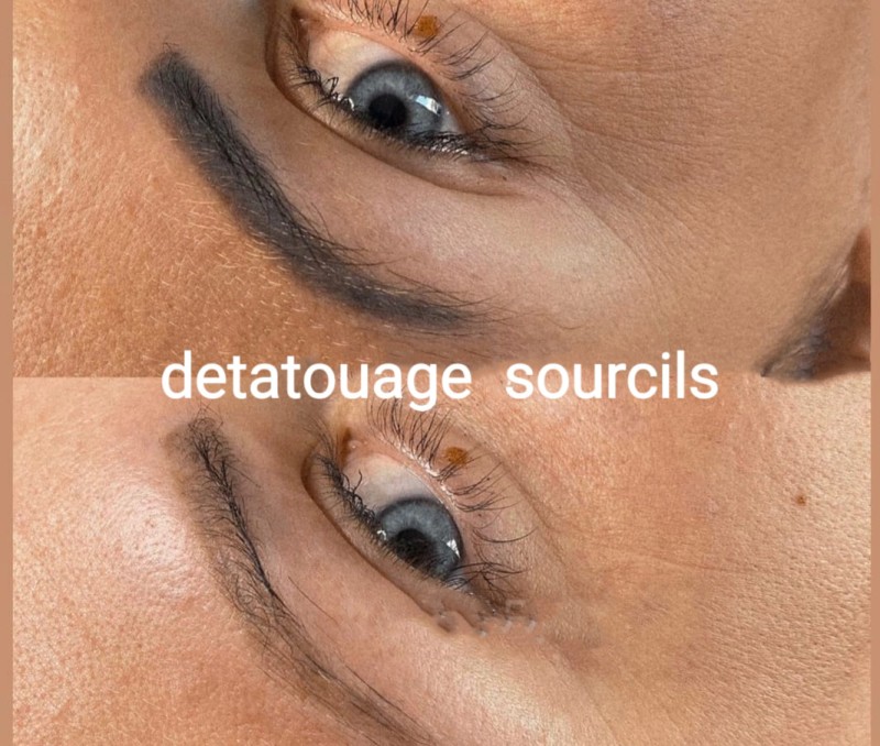 Centre de détatouage : faites disparaitre votre dermopigmentation taches de rousseur à La Ciotat