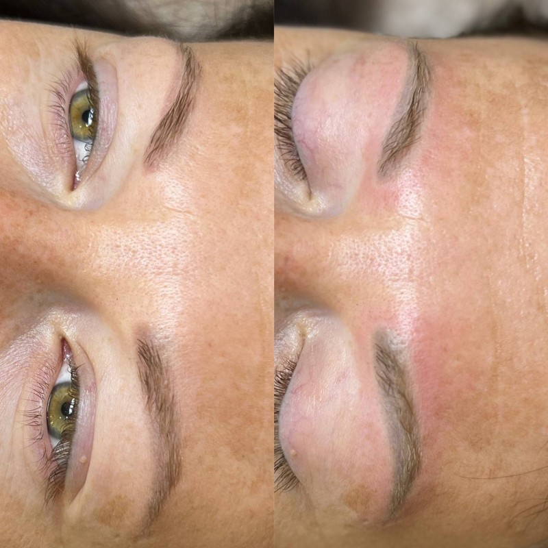 retirer le tatouage Des sourcils efficacement et rapidement Marseille La Ciotat