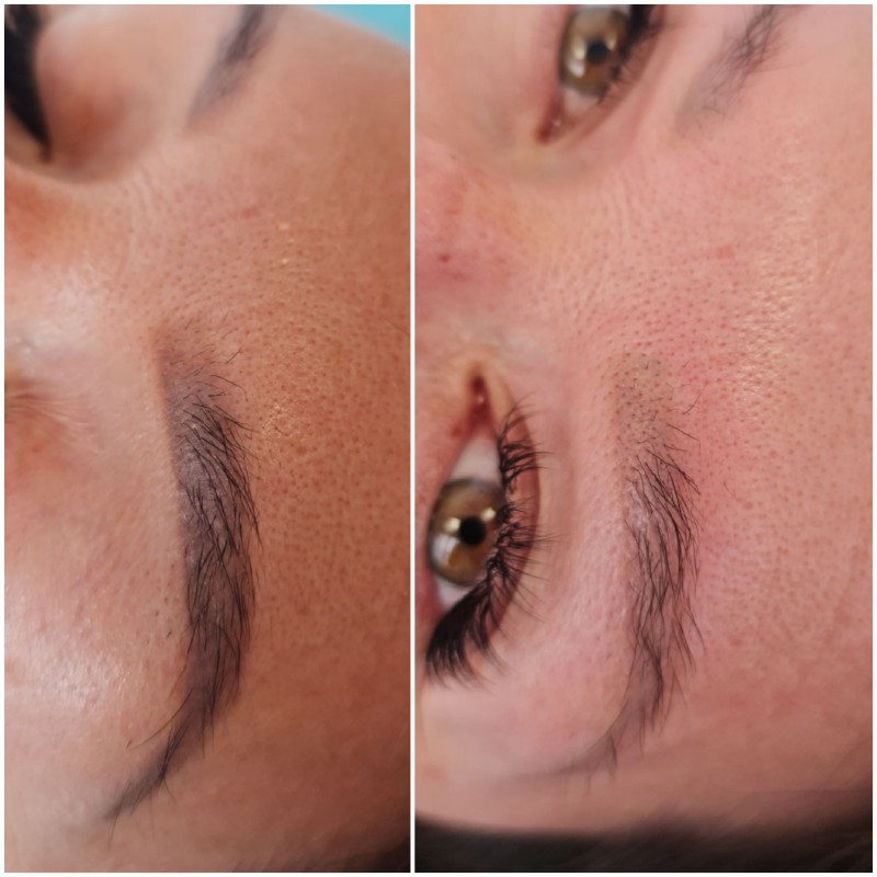 retirer le tatouage Des sourcils efficacement et rapidement Marseille La Ciotat