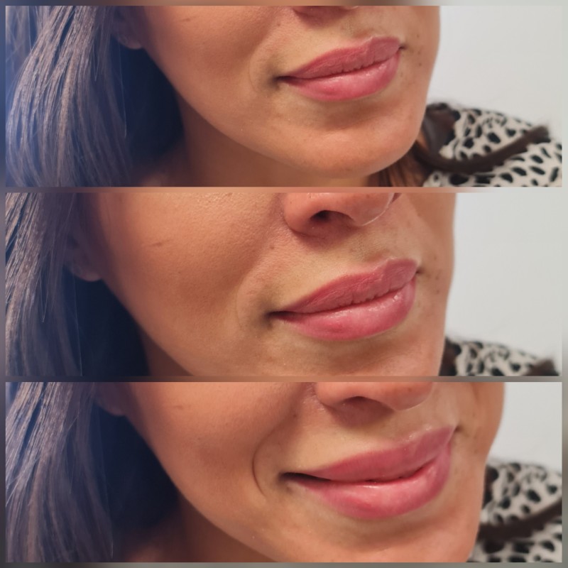 dark lips la solution pour neutraliser les lèvres foncées résultat avant après