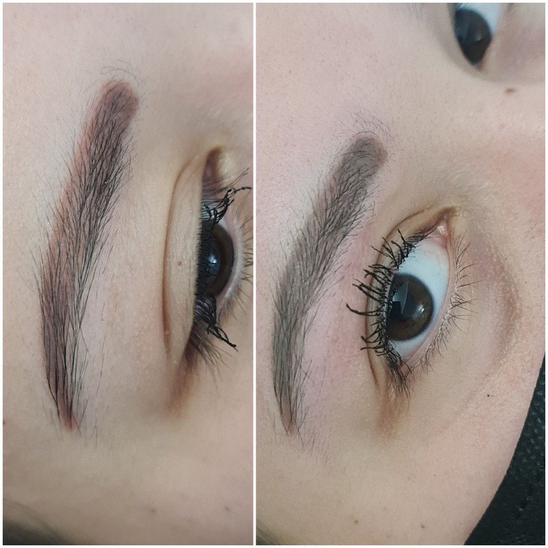 détatouage sourcils laser cicatrisation Aix-en-Provence