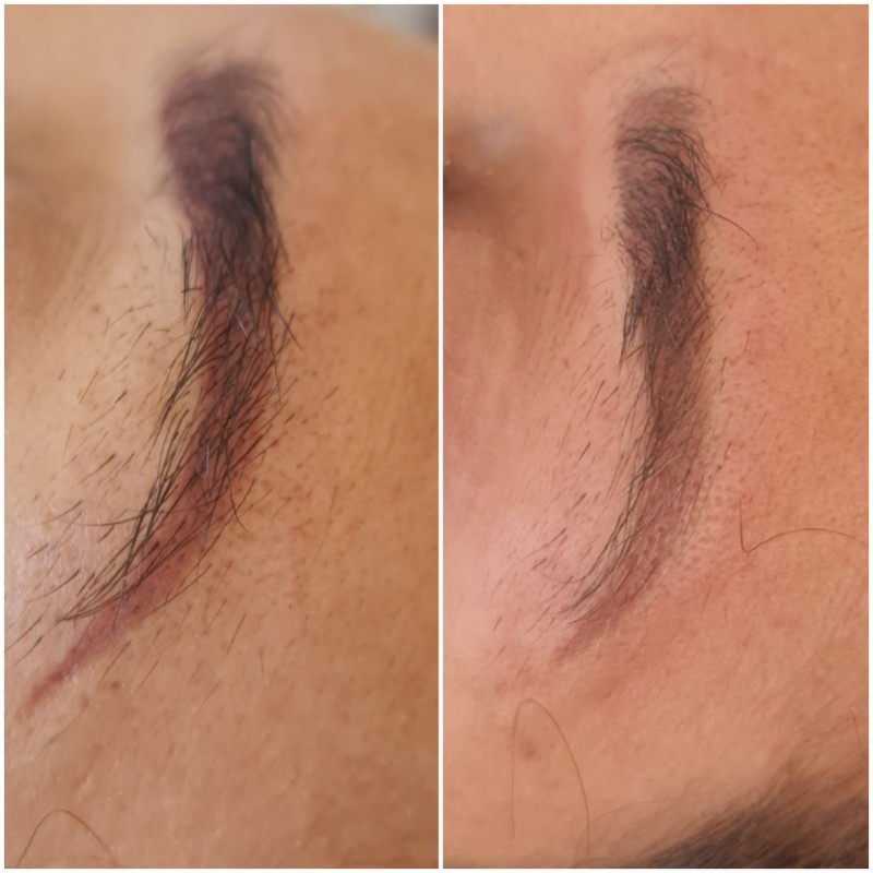 éclaircicemment  de tatouage détatouage en douceur à La Ciotat