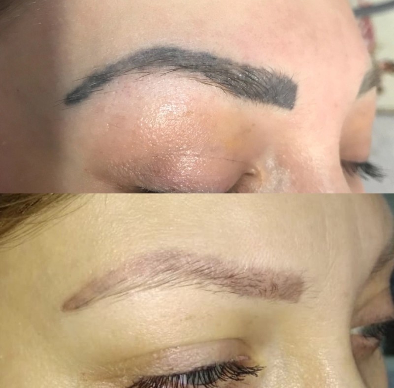 Meilleur détatouage de microblading sourcils rouges Marseille