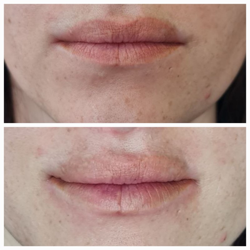 Traitement de détatouage lèvres sur-mesure pour peaux sensibles à La Ciotat avant après