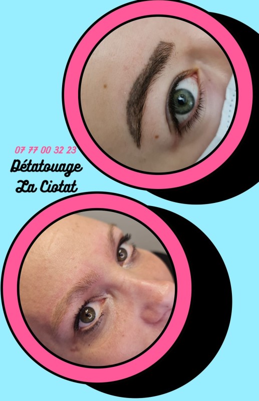 Comment se débarrasser d'un tatouage de sourcils ou de lèvres ?