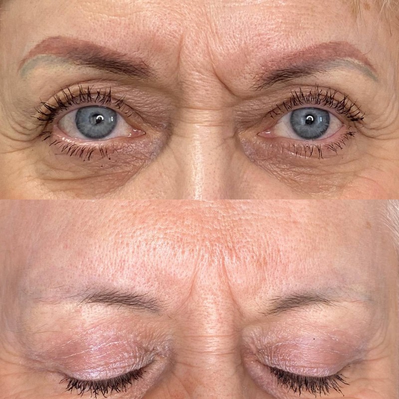 retirer le tatouage Des sourcils efficacement et rapidement Marseille La Ciotat