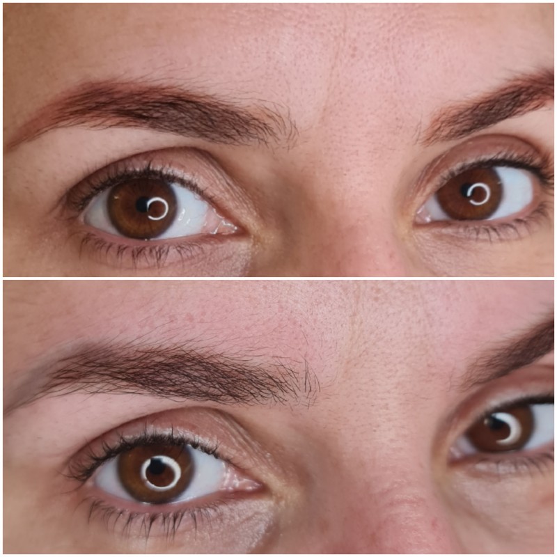 détatouage sourcils laser cicatrisation Aix-en-Provence