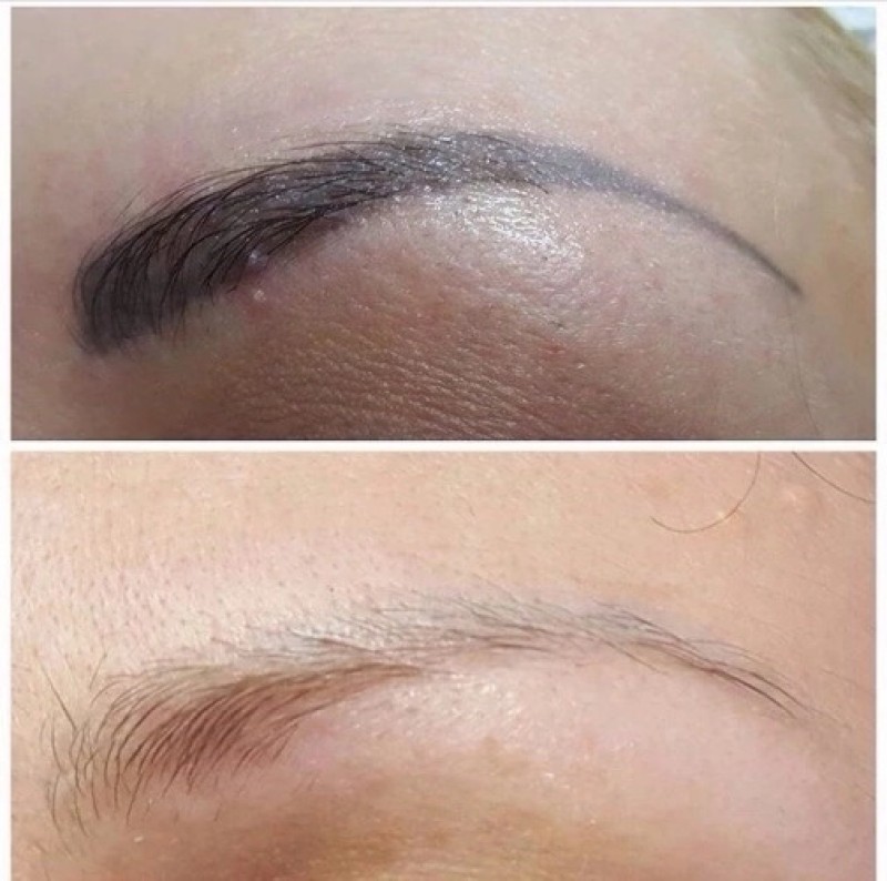 Centre de détatouage : faites disparaitre votre dermopigmentation taches de rousseur à La Ciotat