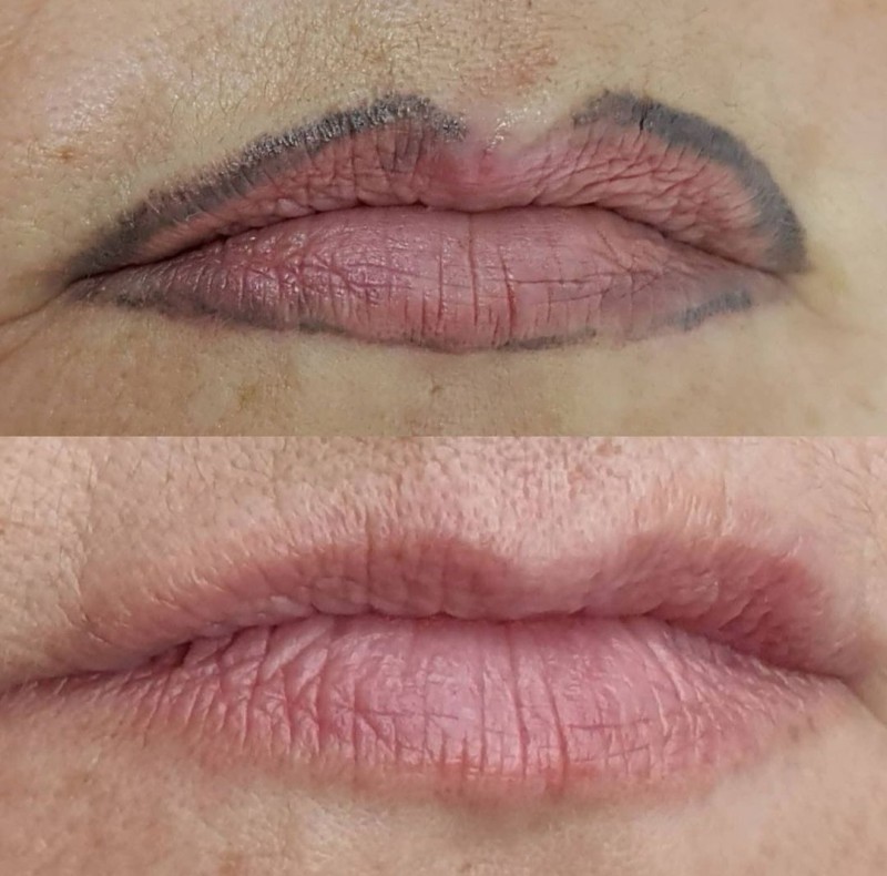 Le détatouage laser à La Ciotat : effacez vos anciens tatouages sans douleur