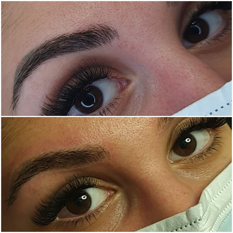 détatouage sourcils laser cicatrisation Aix-en-Provence