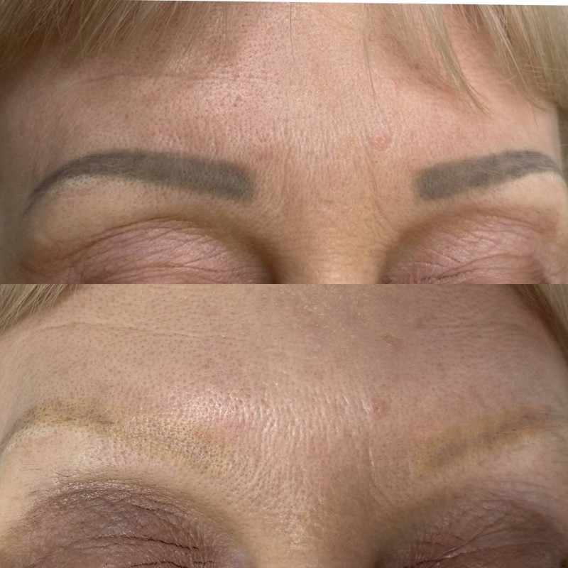retirer le tatouage Des sourcils efficacement et rapidement Marseille La Ciotat