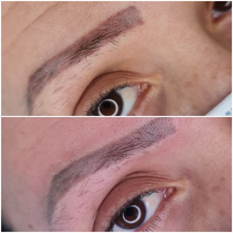 détatouage sourcils laser cicatrisation Aix-en-Provence