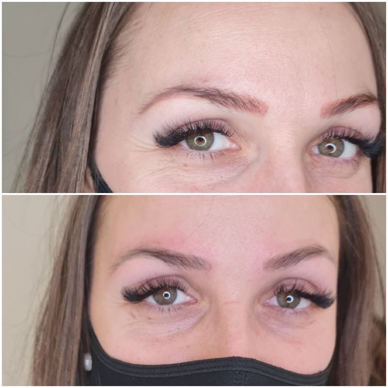 détatouage sourcils laser cicatrisation Aix-en-Provence