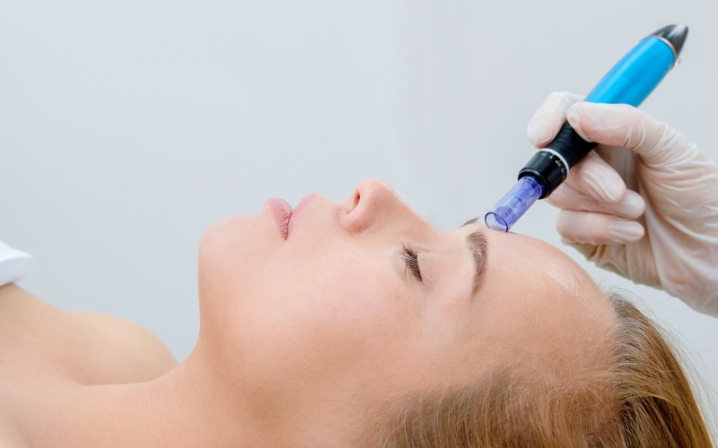 soin de visage  carbon Peel quels sont les bienfaits et quand doit-on le faire ?