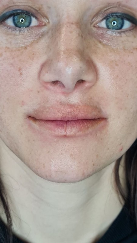 résultat détatouage de maquillage permanent des lèvres complètes