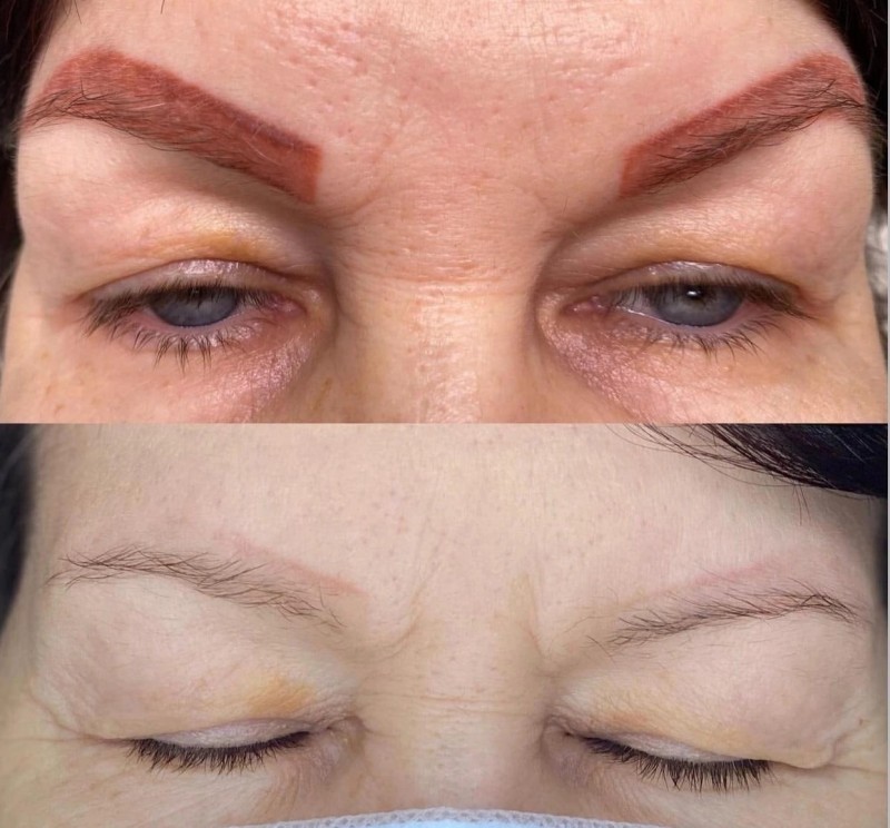 Centre de détatouage : faites disparaitre votre dermopigmentation taches de rousseur à La Ciotat