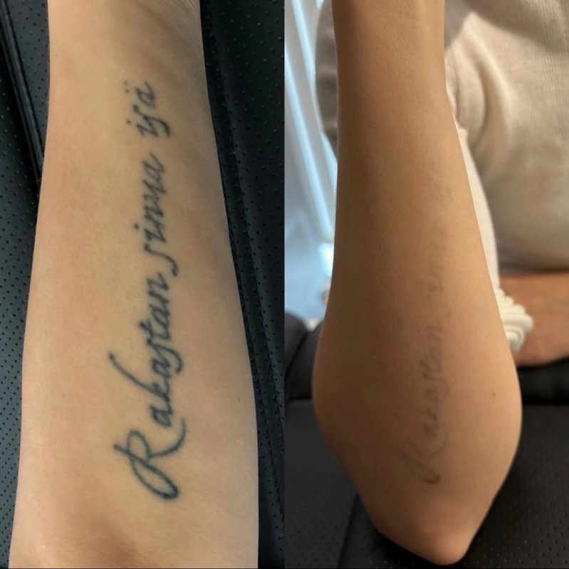 Détatouage laser à La Ciotat : effacez vos tatouages en toute sécurité