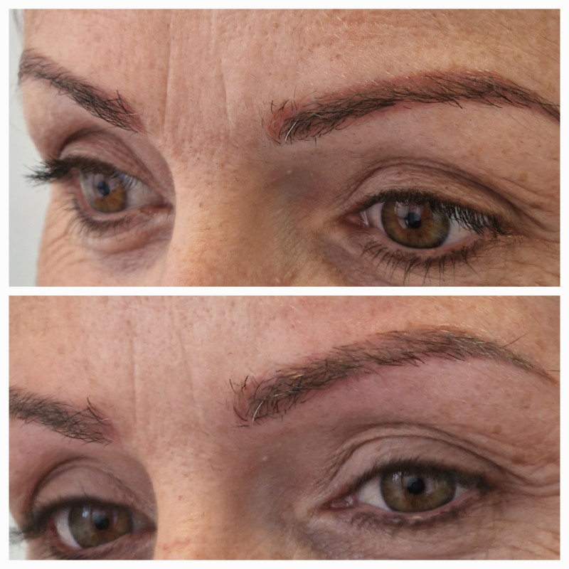résultat détatouage des sourcils virés 1 séance avant/après photo