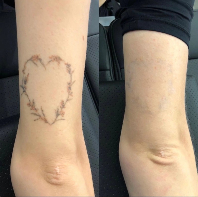 Détatouage laser à La Ciotat : effacez vos tatouages en toute sécurité