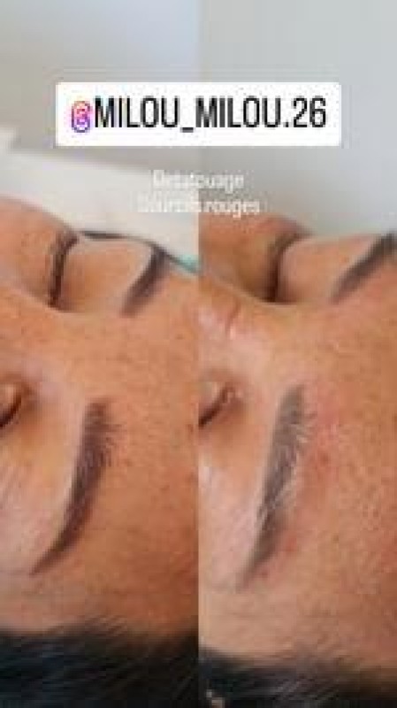 retirer le tatouage Des sourcils efficacement et rapidement Marseille La Ciotat