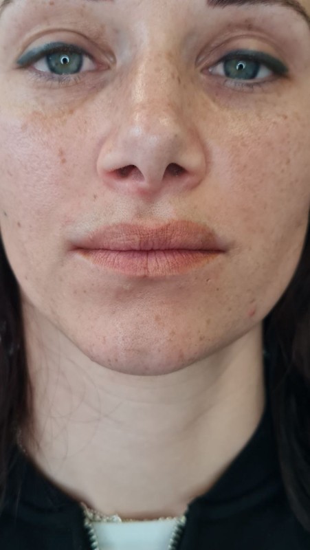 la correction de maquillage permanent des lèvres effacer l'ancien tatouage des lèvres