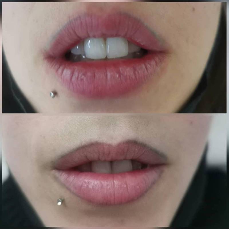 détatouage marseille