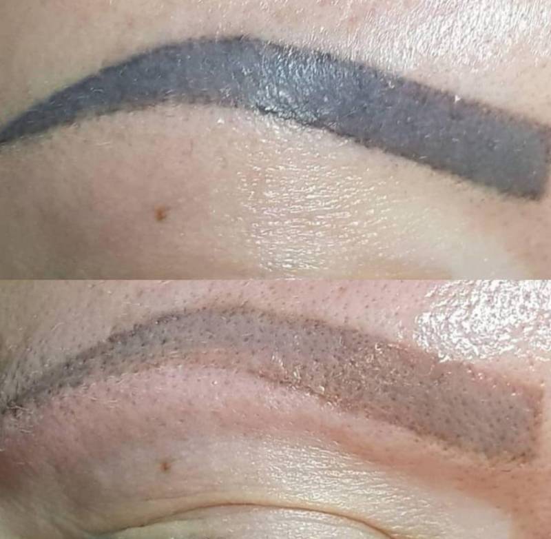 détatouage sourcils marseille