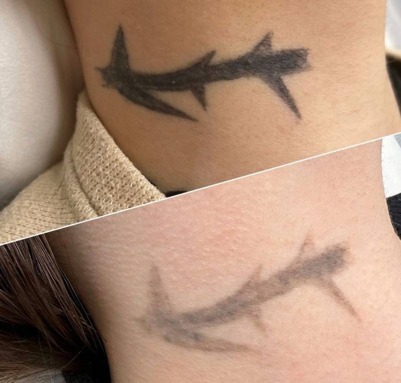 détatouage marseille