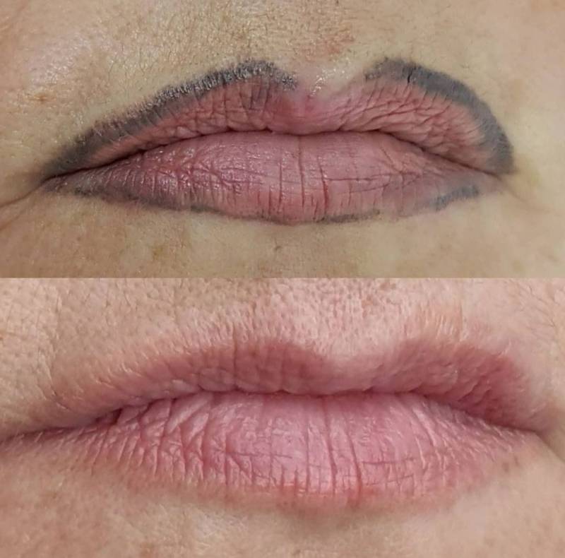 détatouage marseille