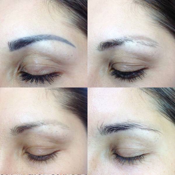 détatouage sourcils marseille