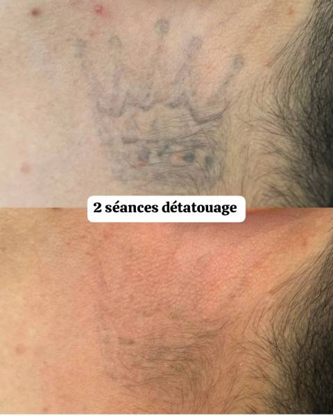 detatouage la ciotat 