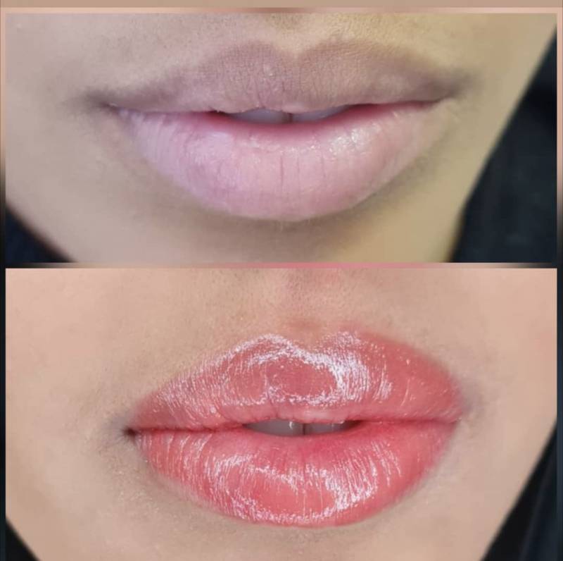 dermopigmentation marseille