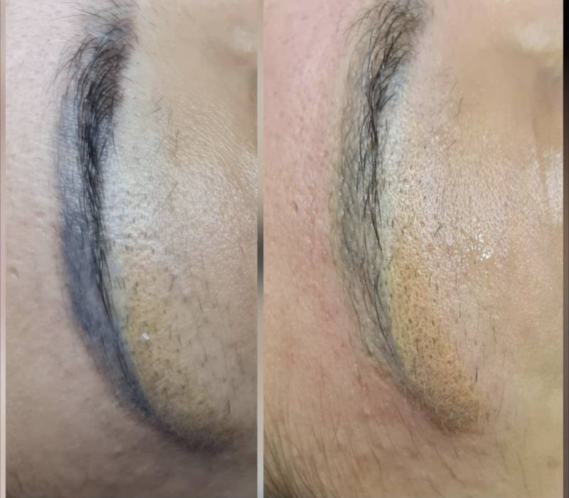 détatouage sourcils la Ciotat