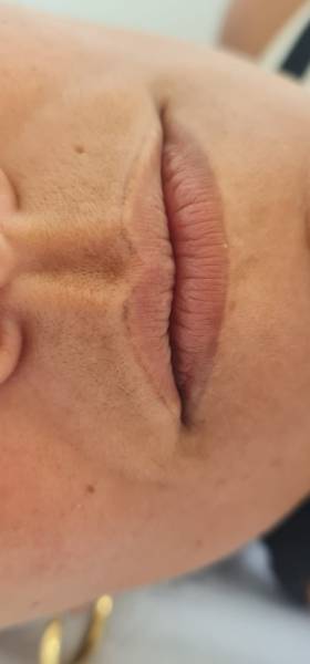 détatouage avant/apres 