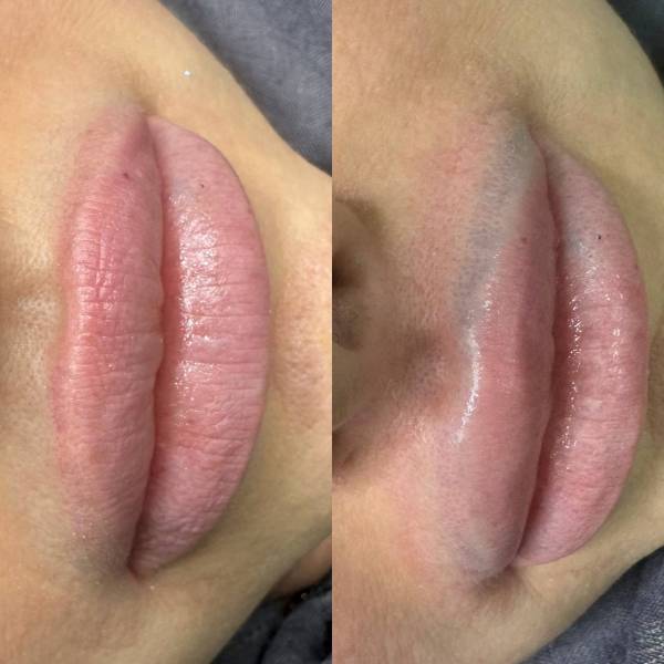 détatouage avant/apres 