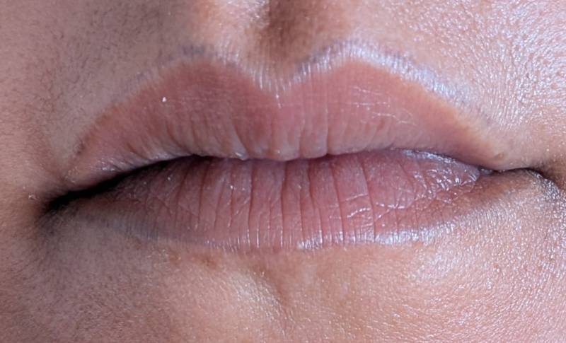 détatouage avant/apres 