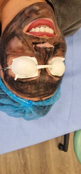 soin visage carbonpeel marseille