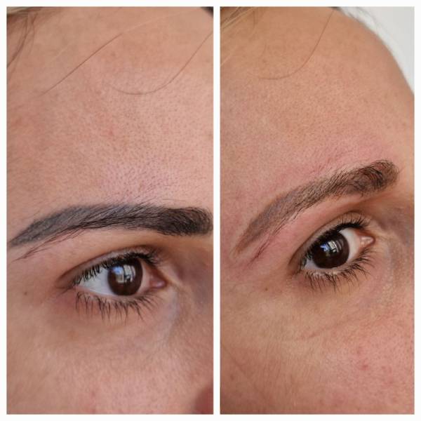 détatouage laser marseille 