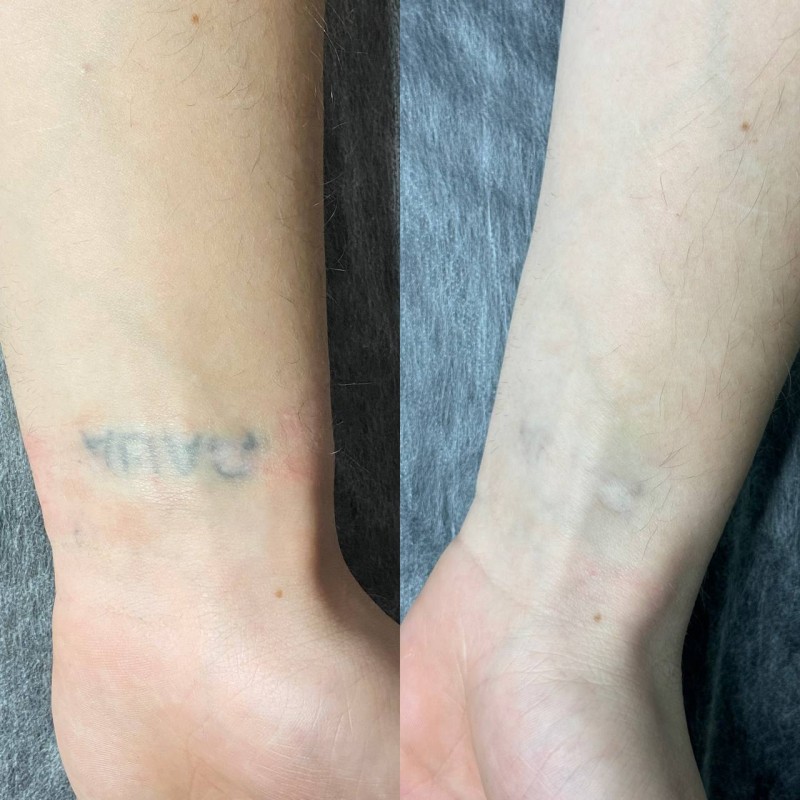 retirer le tatouage Des sourcils efficacement et rapidement Marseille La Ciotat